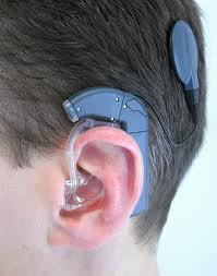 reabilitação auditiva com o implante coclear