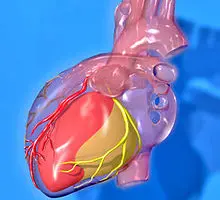 Coração - Infartos em mulheres
