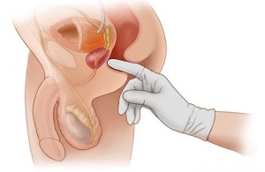 Exame de toque preventivo para o câncer de próstata