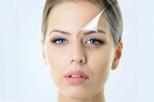 O lifting facial ou ritidectomia é um procedimento cirúrgico que reduz as rugas e marcas de expressão